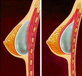 Diagram of implant in breast